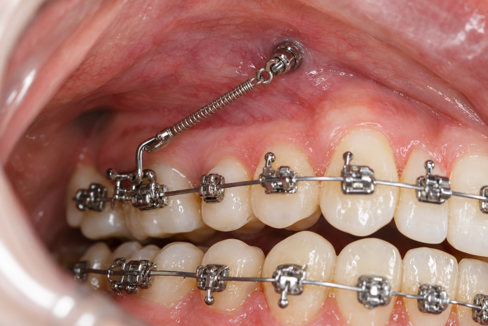 Close-up van orthodontische beugel en miniscrew.png