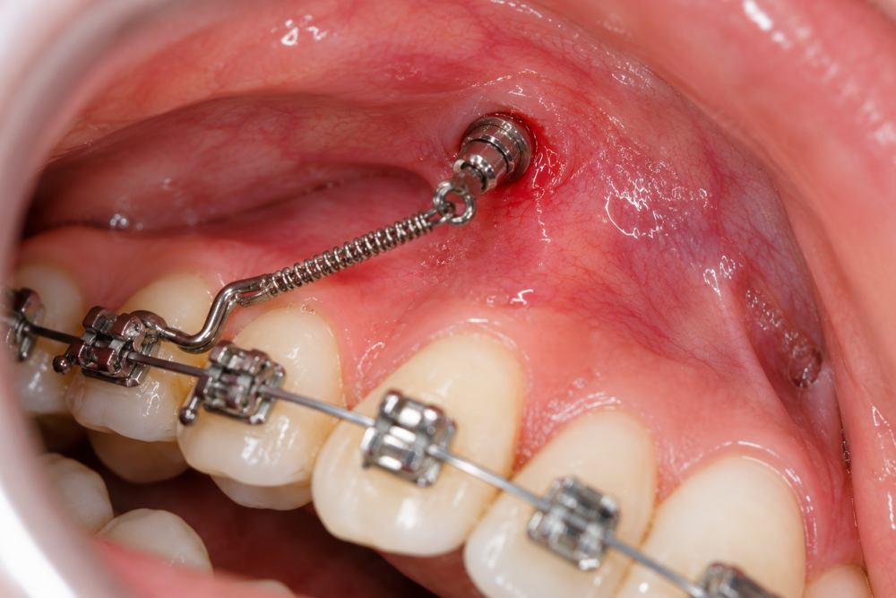 Klinische close-up van een orthodontische miniscrew.png